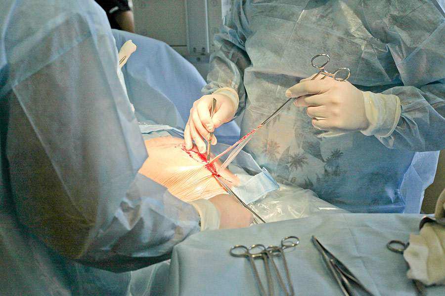 Операция кесарево сечение